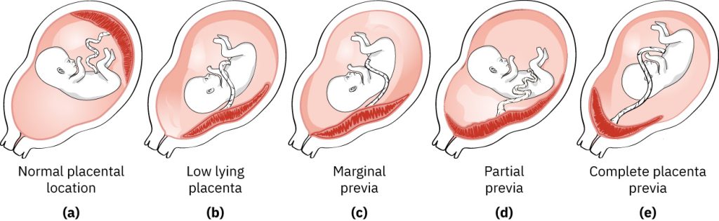 Illustration showing five variations of placenta previa