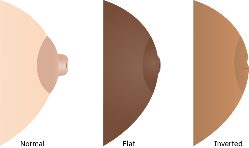 Illustration showing a comparison of Normal, Flat, and Inverted Nipples