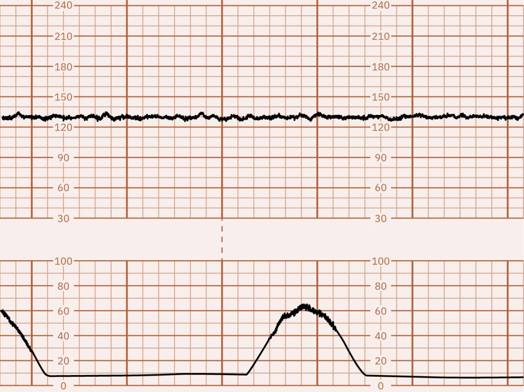 Image of graph paper showing minimal FHR variability