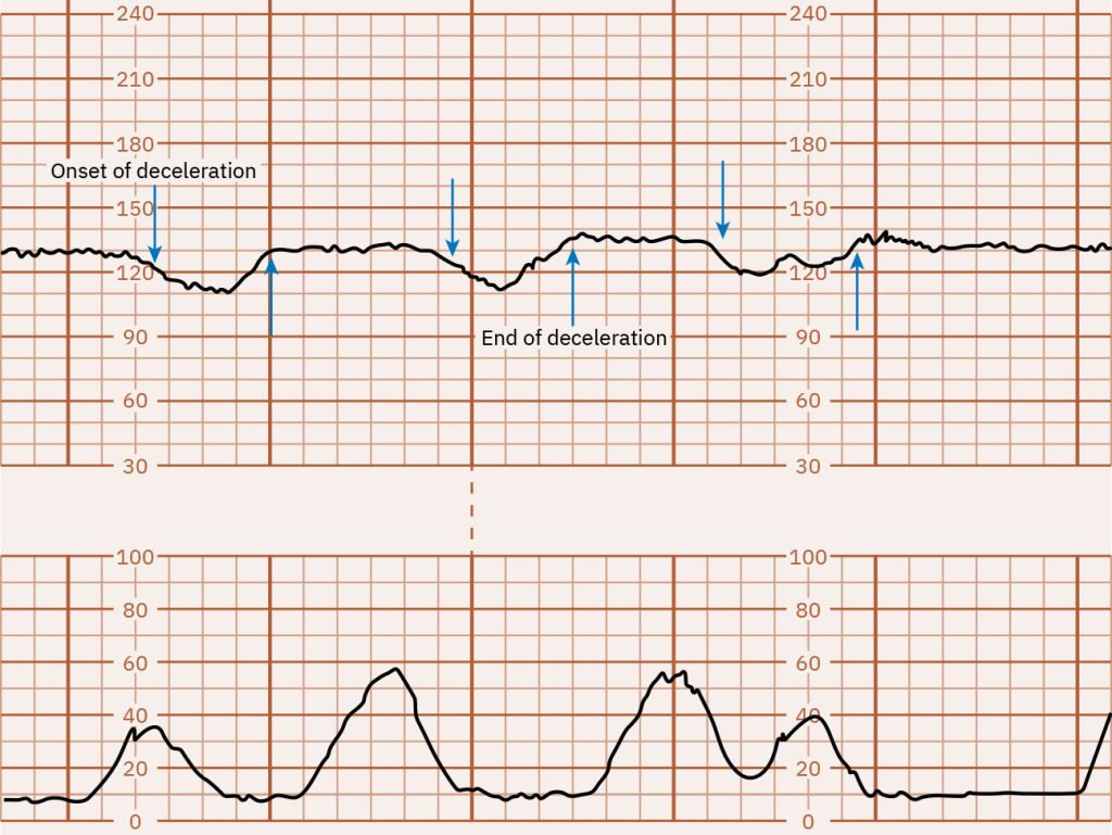 Image of graph paper showing late decelerations