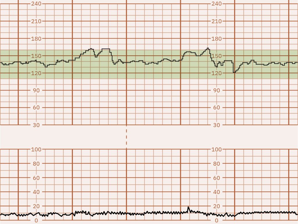 Image of graph paper showing Moderate FHR Variability