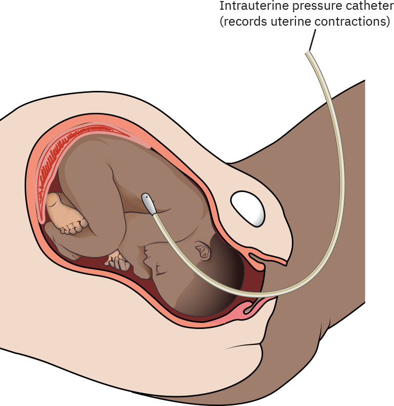 Illustration showing placement of intrauterine pressure catheter