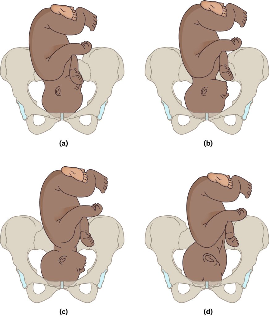 Illustration showing four vertex presentations ranging from normal to full extension of the head