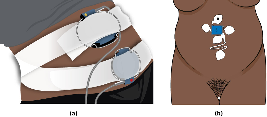 Illustration showing continuous external fetal monitoring devices