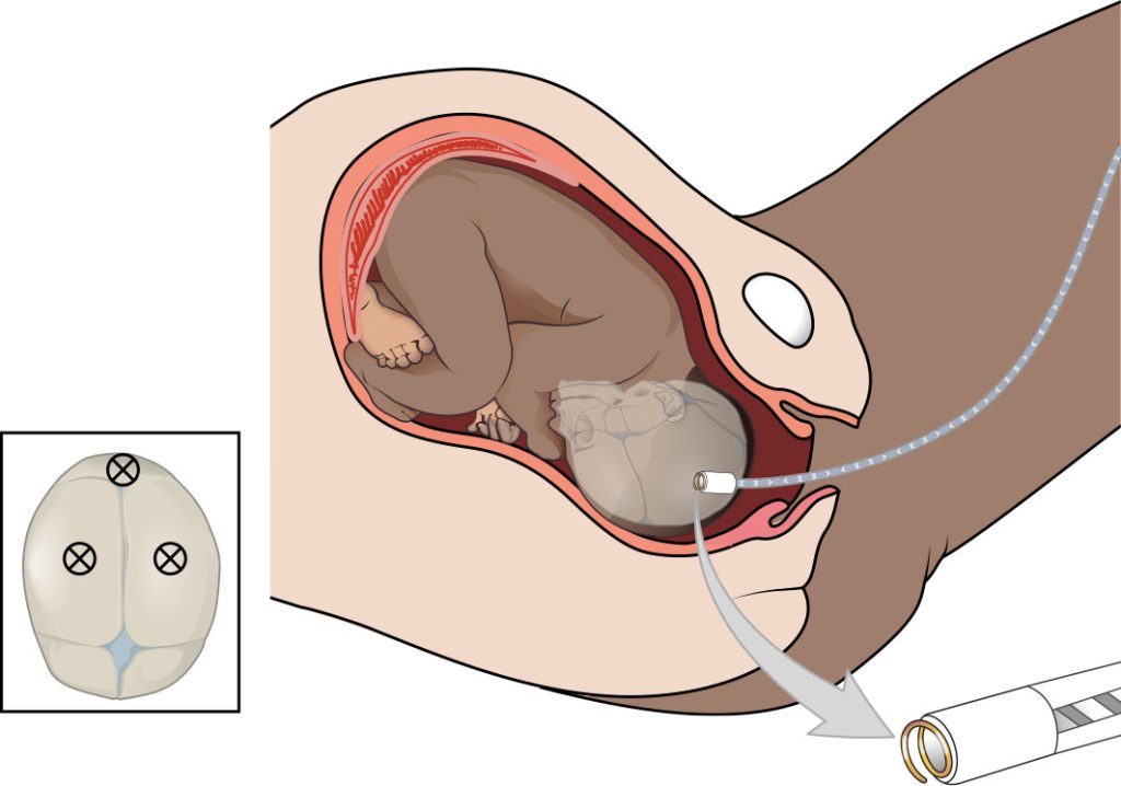 Illustration showing placement of fetal scalp electrode