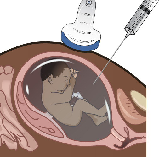 Illustration showing an amniocentesis procedure