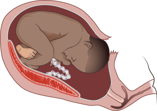 Illustration showing a uterine rupture