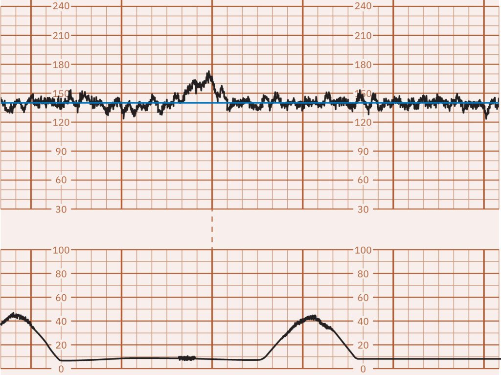 Image of graph paper showing Fetal Heart Rate Baseline