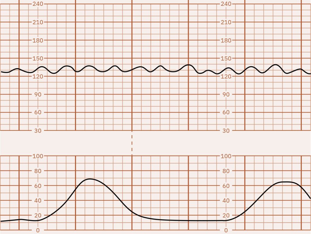 Image of graph paper showing sinusoidal FHR pattern