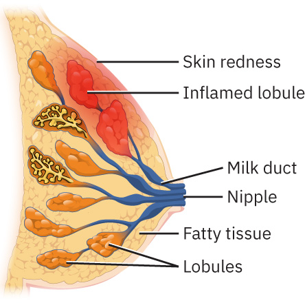 Illustration showing a breast with mastitis with text labels for major structures