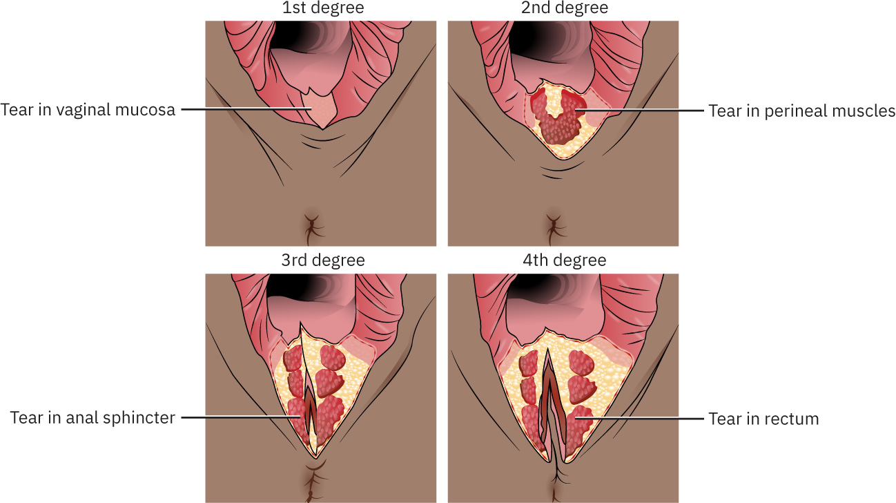 Illustrations showing four degrees of lacerations