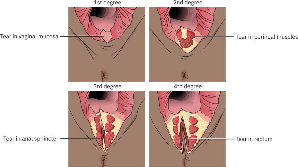 Illustration showing four degrees of perineal lacerations