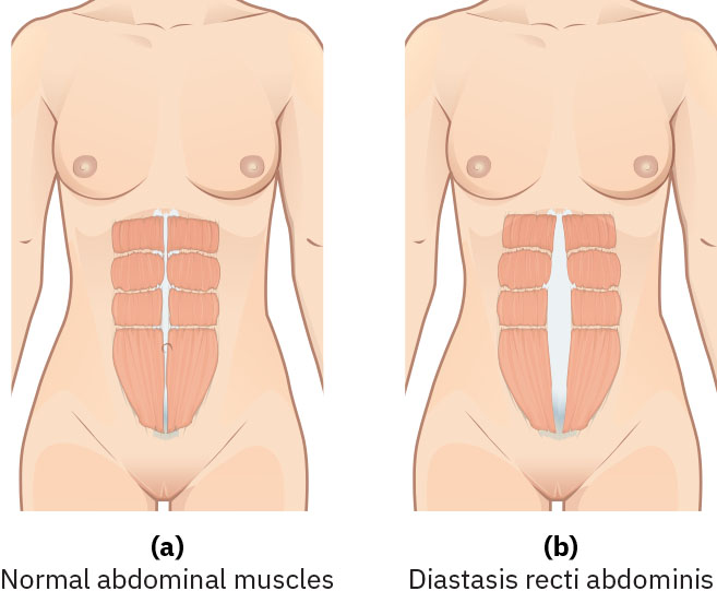 Illustration showing a comparison between normal abdominal muscles and Diastasis Recti Abdominis