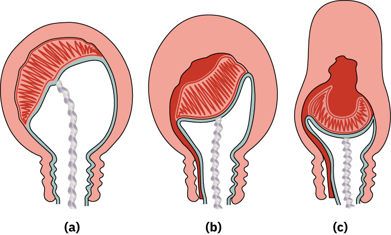 Illustration showing stages of separation of the placenta