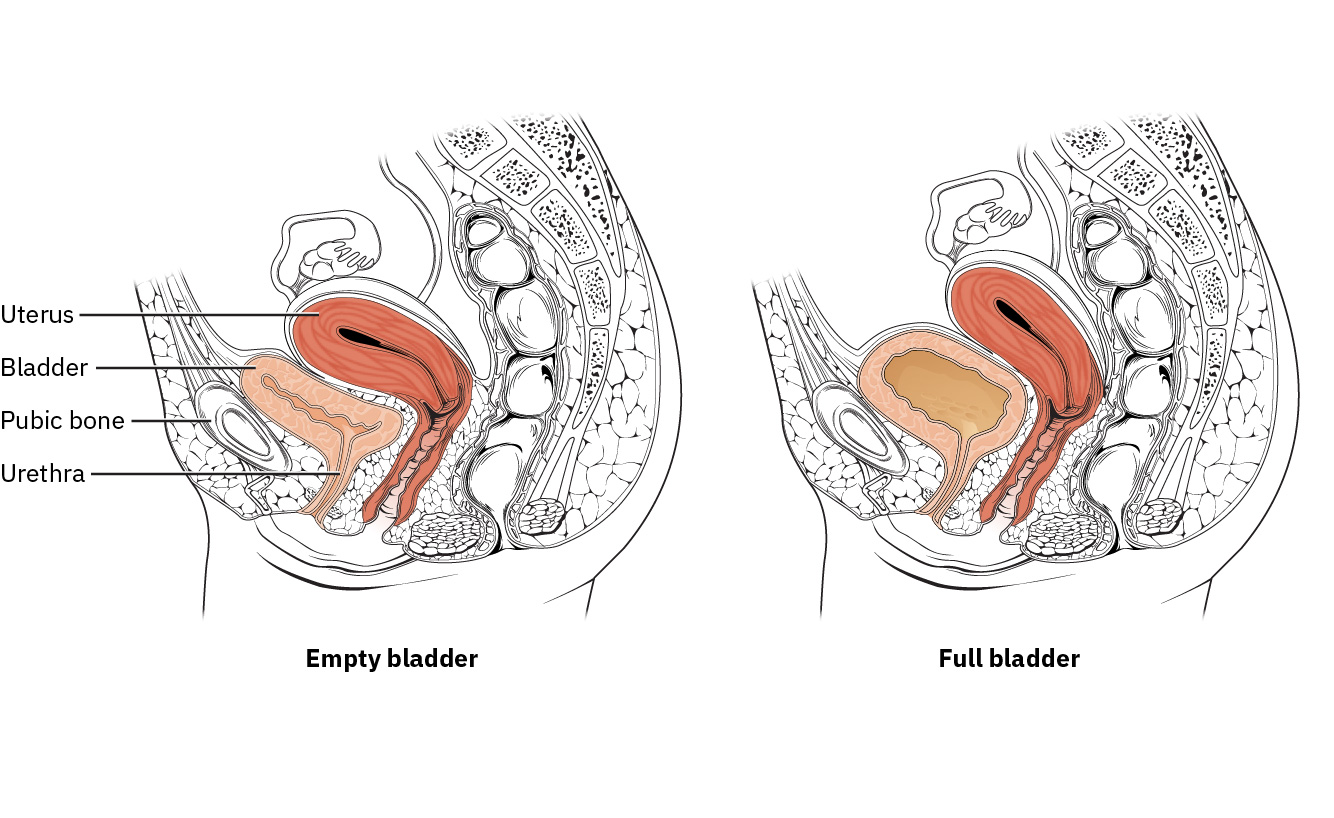 Illustration showing displaced uterus due to bladder distension