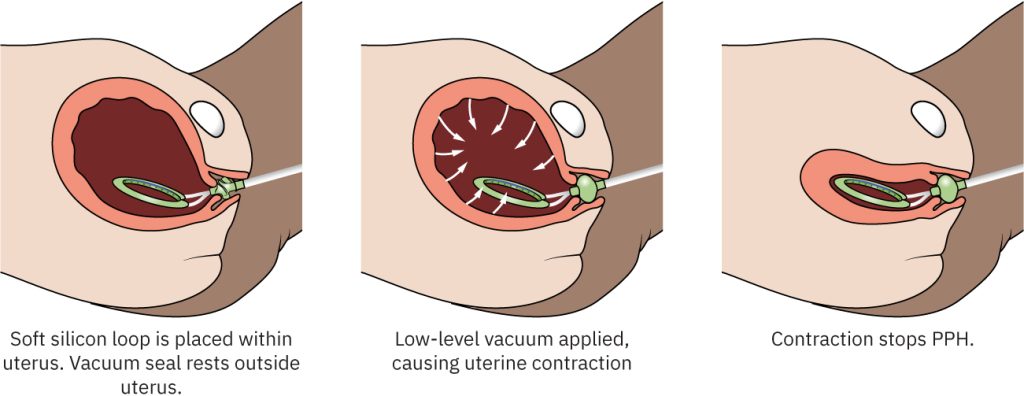 Illustration showing the use of the Jada system in a uterus