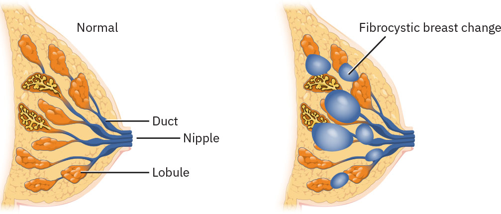 Illustration showing a comparison between a normal breast and one with fibrocystic changes