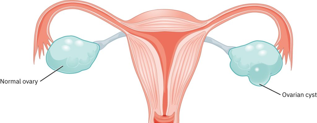 Illustration showing locations and appearance of an ovarian cyst