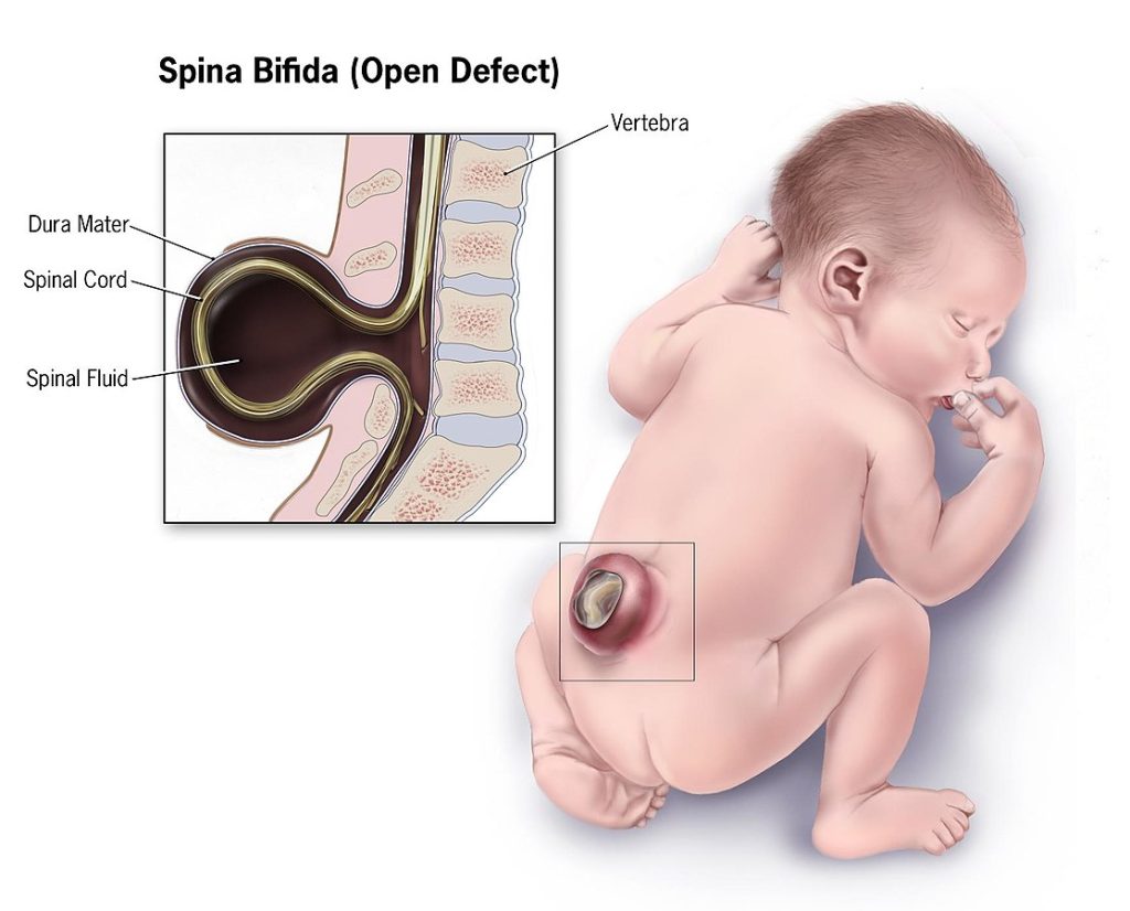 Illustration showing an infant with spina bifida, including an internal view