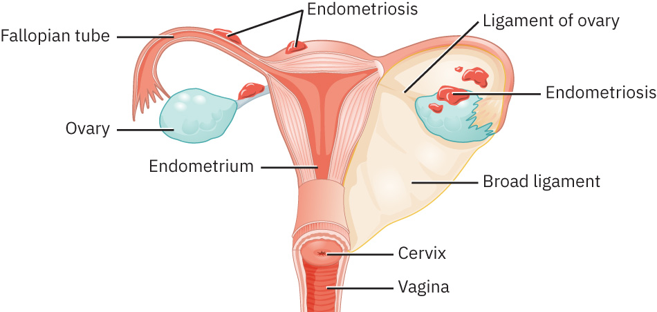 Illustration showing location and appearance of endometriosis