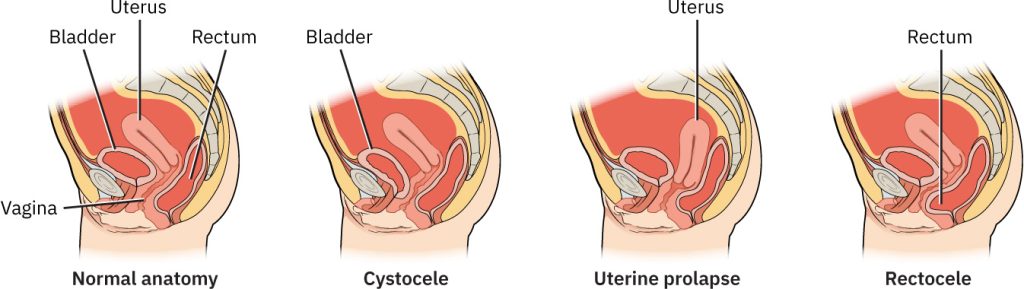 Illustration showing four types of Pelvic Organ Prolapse