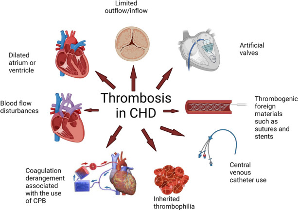 Illustration showing Causative Factors of Thrombosis in Congenital Heart Disease