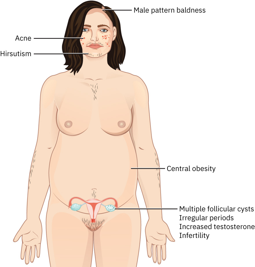 Illustration showing a female figure with exhibiting various Signs of Polycystic Ovarian Syndrome (PCOS)