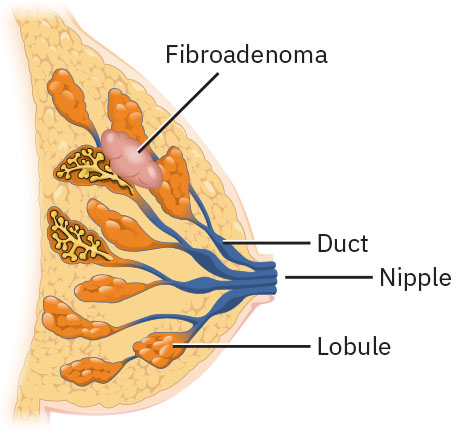 Illustration showing a breast fibroadenoma