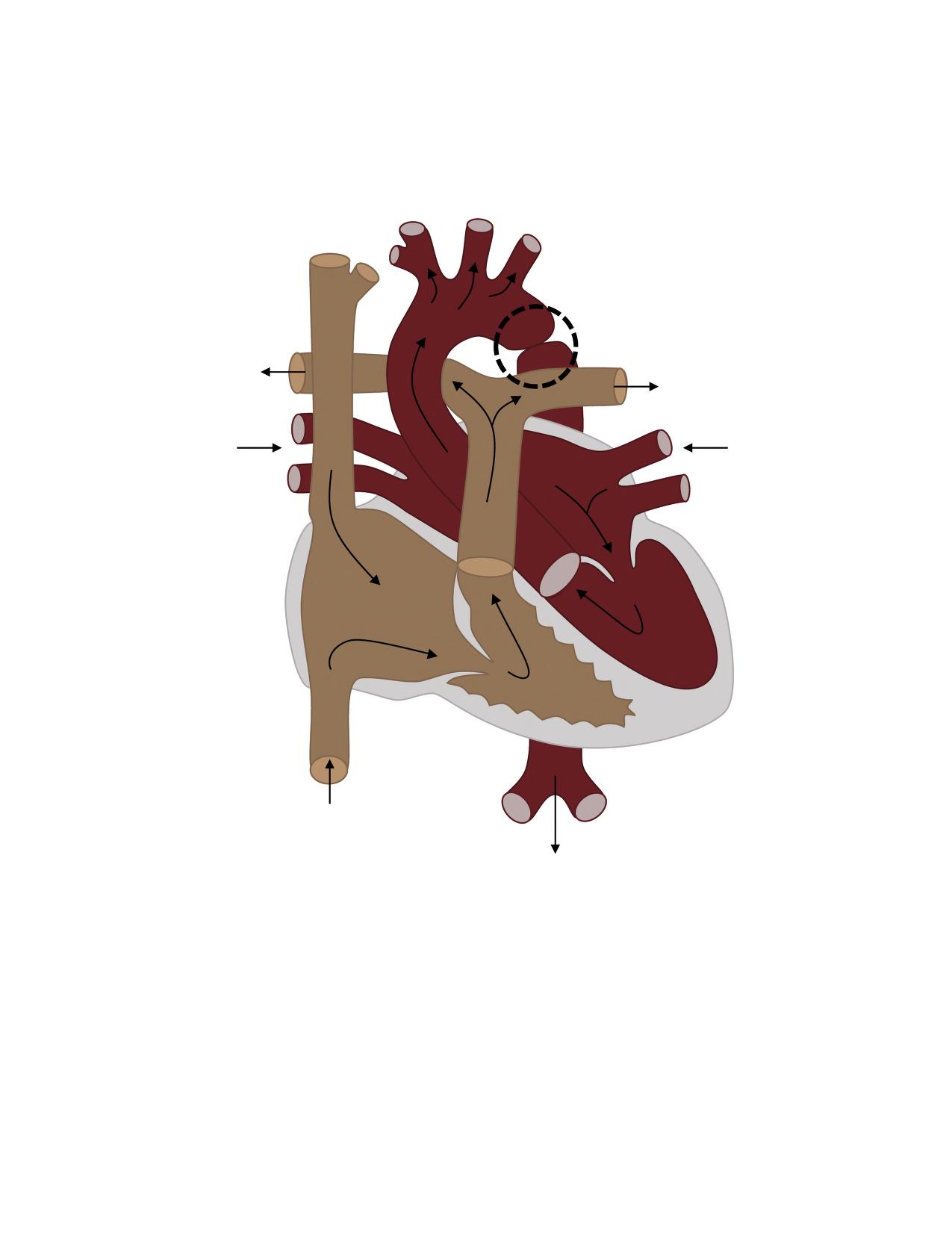 Illustration showing Coarctation of the Aorta