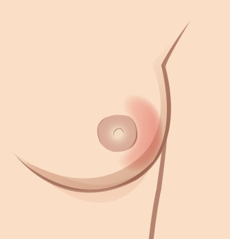 Illustration showing a rash on a breast, indicative of Periductal Mastitis