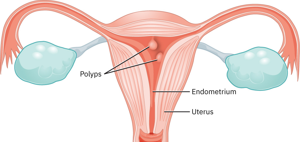 Illustration showing location and appearance of uterine polyps