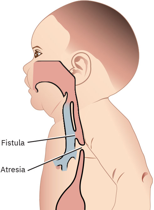 Illustration showing Esophageal Atresia and Tracheoesophageal Fistula