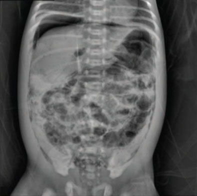 Image showing an Abdominal X-ray of an Infant with Necrotizing Enterocolitis and Intramural Gas Bubbles