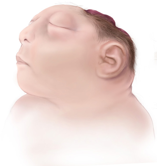 Illustration showing anencephaly