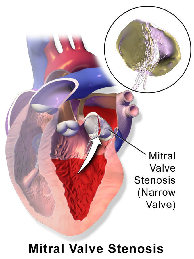 Image showing Mitral Stenosis