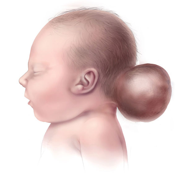 Illustration showing an infant with an encephalocele