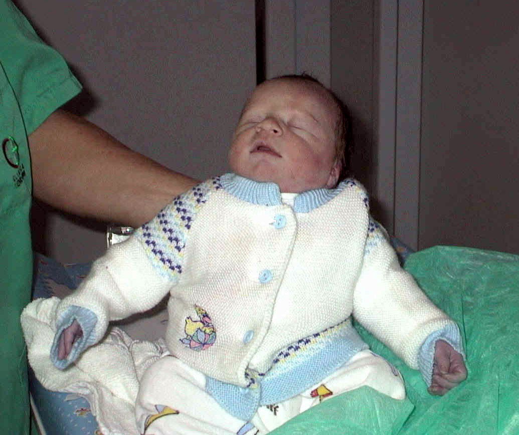 Image showing an infant with cyanosis