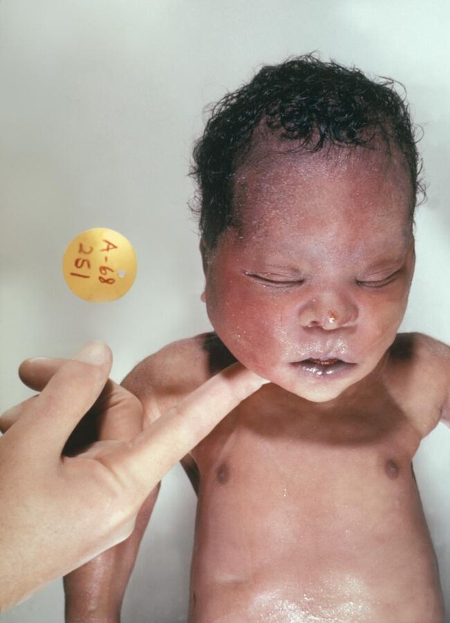 Image showing a newborn with a down syndrome