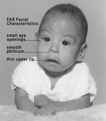 Image showing an infant with Facial Characteristics of Fetal Alcohol Syndrome