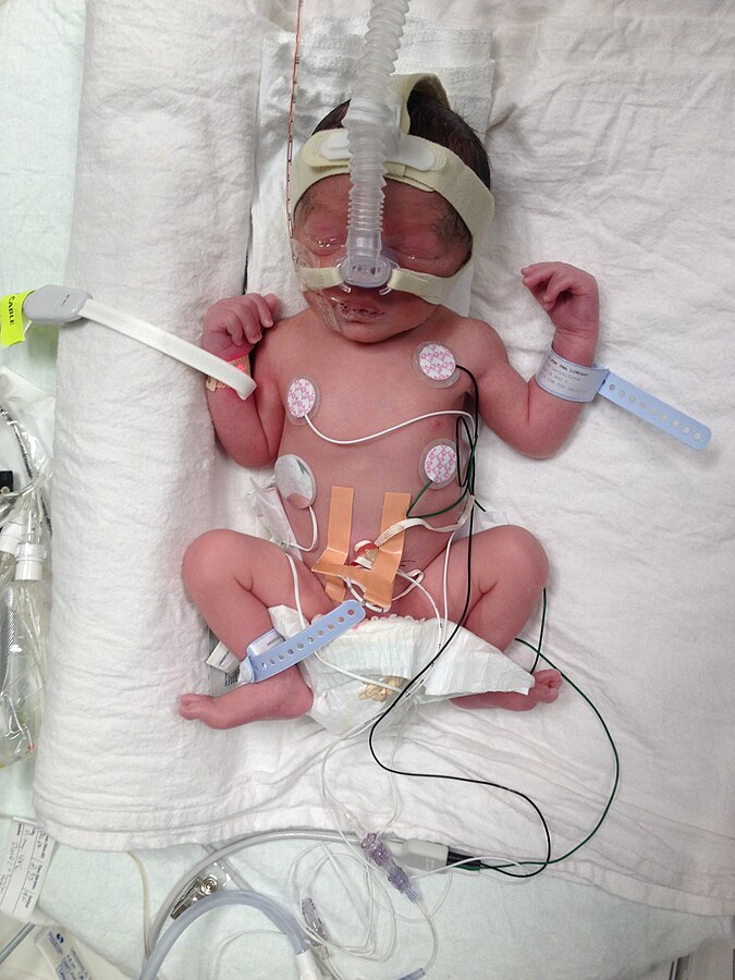 Image showing a Premature Infant in NICU