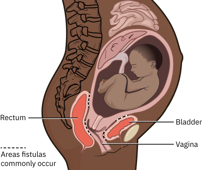 Illustration showing location and appearance of Reproductive System Fistulas