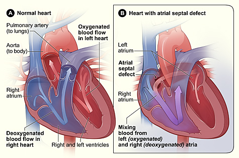 Illustration showing a Comparison of a Normal Heart to a Heart With Atrial Septal Defect