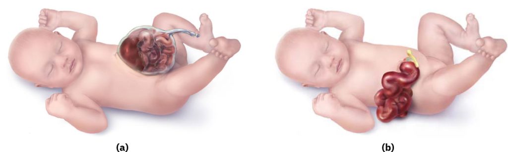 Image showing two infants, one with an omphalocele and one with gastroschisis