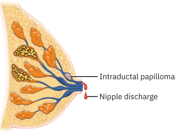 Illustration showing a indraductal papilloma