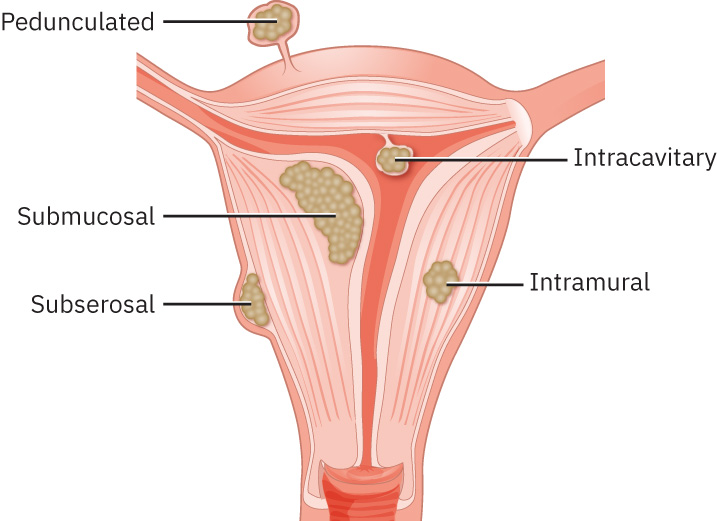 Illustration showing location and appearance of fibroids