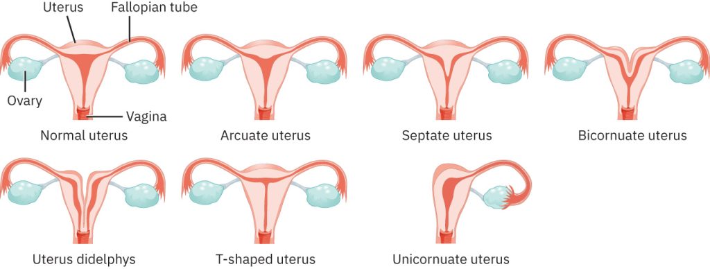 Illustration showing seven Congenital Abnormalities of the Uterus