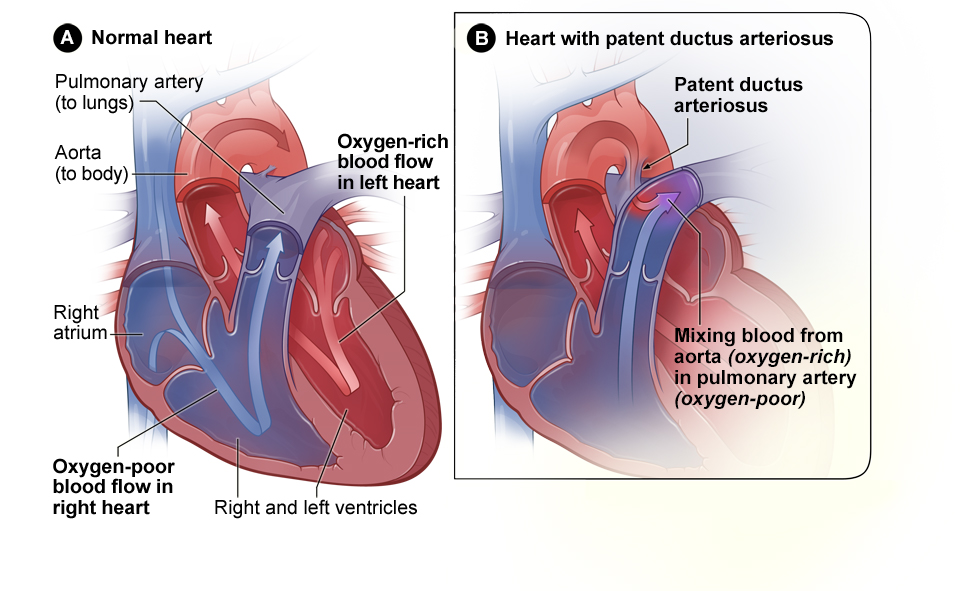 Illustration showing a Comparison of a Normal Heart to a Heart With Patent Ductus Arteriosus