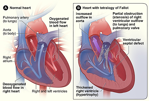 Illustration showing a Comparison of a Normal Heart to a Heart With Tetralogy of Fallot