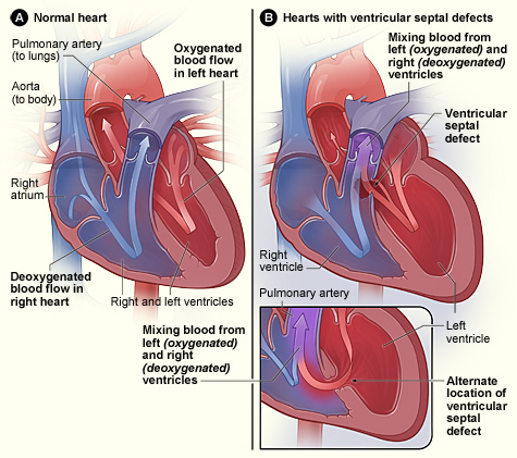 Illustration showing a Comparison of a Normal Heart to a Heart With Ventricular Septal Defect