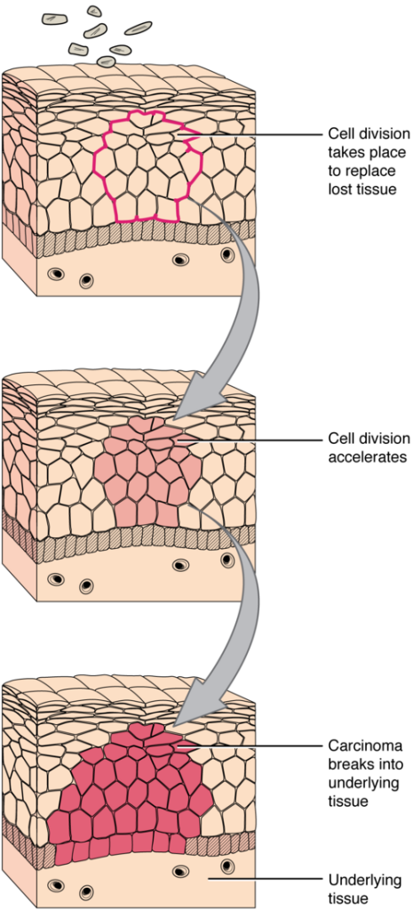 "418_Development_of_Cancer" by OpenStax College is licensed under CC BY 3.0. Illustration showing the how cancer progresses as the cellular level